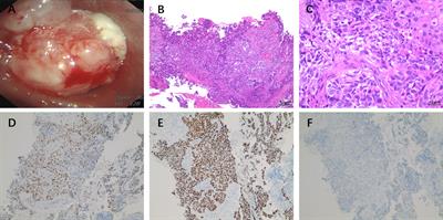 BRCA2 mutation in advanced lung squamous cell carcinoma treated with Olaparib and a PD-1 inhibitor: a case report